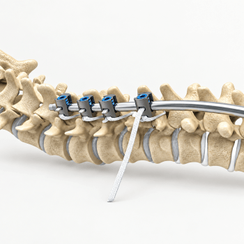 OsteoPoint™  <br> Cerclage Band Systems