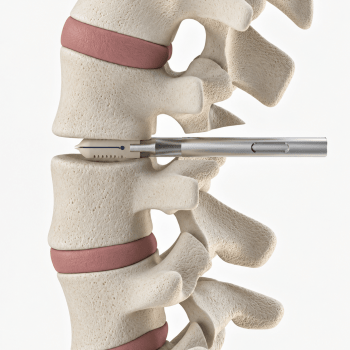 OsteoPoint™  <br> Interbody Fusion Systems